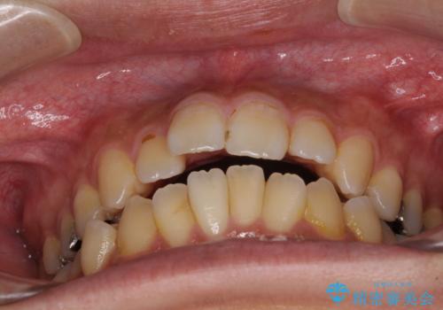 オープンバイトと目立つ銀歯 インビザライン矯正とセラミック修復治療の治療前