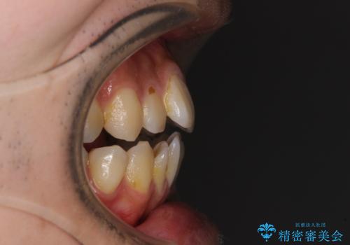 オープンバイトと目立つ銀歯 インビザライン矯正とセラミック修復治療の治療前