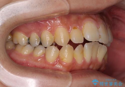 オープンバイトと目立つ銀歯 インビザライン矯正とセラミック修復治療の治療前