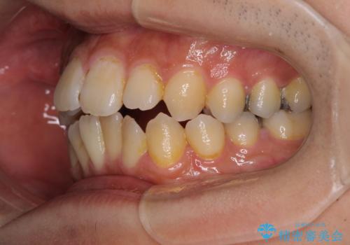 オープンバイトと目立つ銀歯 インビザライン矯正とセラミック修復治療の治療前