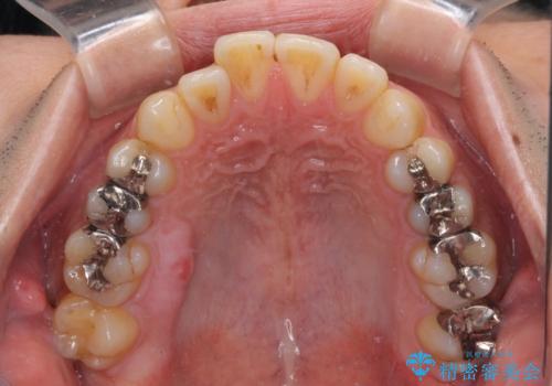 オープンバイトと目立つ銀歯 インビザライン矯正とセラミック修復治療の治療前