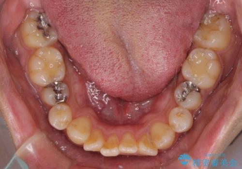 オープンバイトと目立つ銀歯 インビザライン矯正とセラミック修復治療の治療前