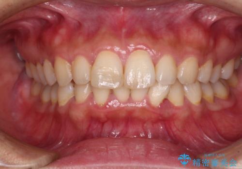 転んで欠けてしまった前歯 オーダーメイドのオールセラミッククラウンの治療前