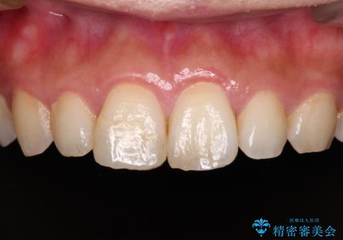 転んで欠けてしまった前歯 オーダーメイドのオールセラミッククラウンの症例 治療前