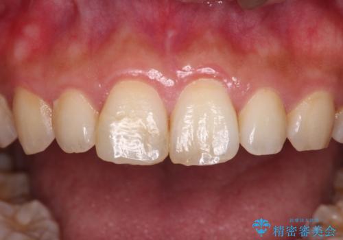 転んで欠けてしまった前歯 オーダーメイドのオールセラミッククラウンの治療前