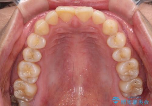 転んで欠けてしまった前歯 オーダーメイドのオールセラミッククラウンの治療前