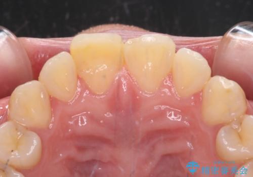 転んで欠けてしまった前歯 オーダーメイドのオールセラミッククラウンの治療前