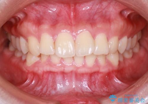 【インビザライン】翼状捻転+出っ歯を治したいの治療前