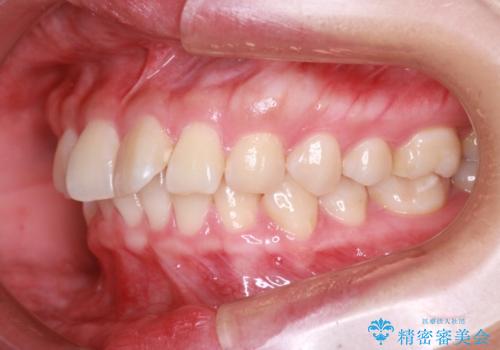 【インビザライン】翼状捻転+出っ歯を治したいの治療前