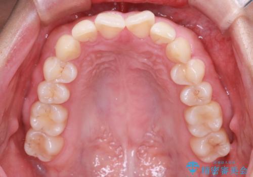 【インビザライン】翼状捻転+出っ歯を治したいの治療前