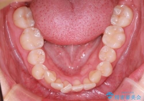【インビザライン】翼状捻転+出っ歯を治したいの治療前