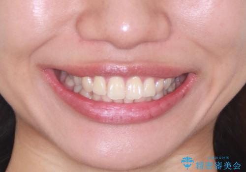 【インビザライン】翼状捻転+出っ歯を治したいの治療前