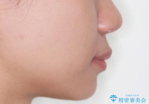 【インビザライン】翼状捻転+出っ歯を治したいの治療前