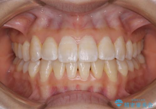 前歯のがたつきとオープンバイト:インビザラインでまとめて治すの症例 治療後