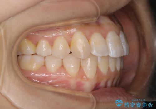 前歯のがたつきとオープンバイト:インビザラインでまとめて治すの治療後