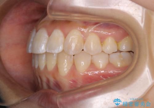 前歯のがたつきとオープンバイト:インビザラインでまとめて治すの治療後