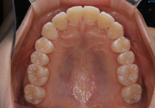 前歯のがたつきとオープンバイト:インビザラインでまとめて治すの治療後