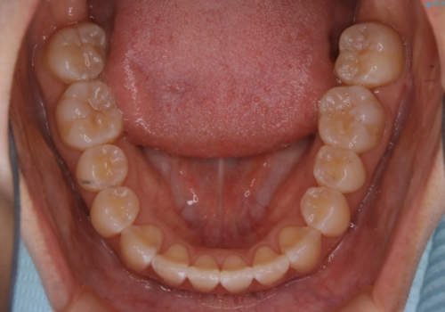 前歯のがたつきとオープンバイト:インビザラインでまとめて治すの治療後