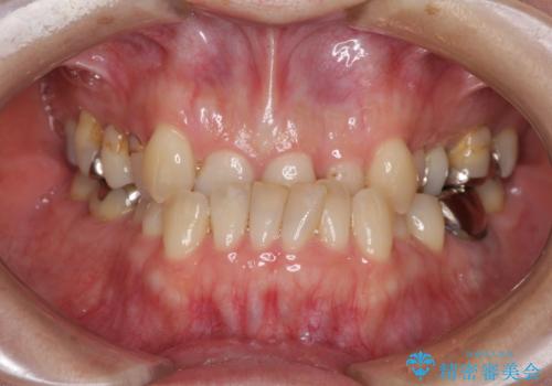 急速拡大装置　前歯の反対咬合をインビザラインで改善の症例 治療前