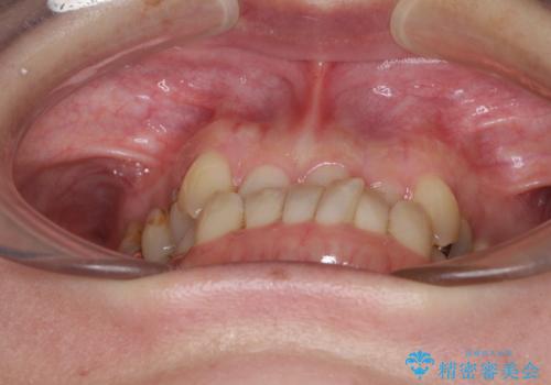 急速拡大装置　前歯の反対咬合をインビザラインで改善の治療前