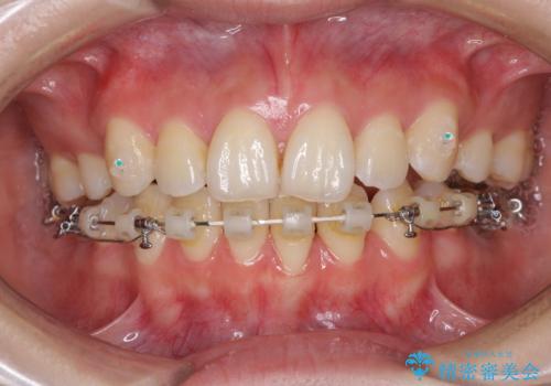 目立たない裏側矯正で突出感を改善 ハーフリンガル矯正の治療中