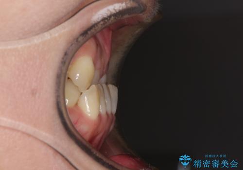 急速拡大装置　前歯の反対咬合をインビザラインで改善の治療前