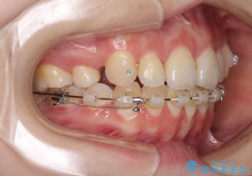 目立たない裏側矯正で突出感を改善 ハーフリンガル矯正の治療中