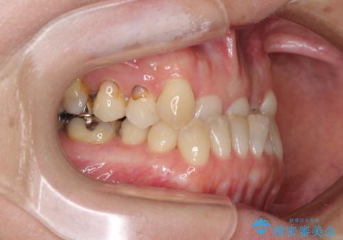 急速拡大装置 前歯の反対咬合をインビザラインで改善の治療前