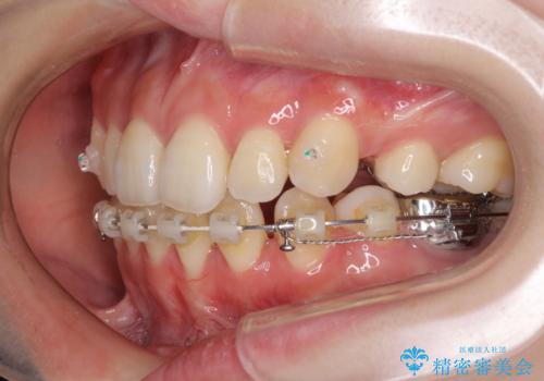目立たない裏側矯正で突出感を改善 ハーフリンガル矯正の治療中