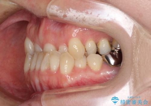 急速拡大装置 前歯の反対咬合をインビザラインで改善の治療前