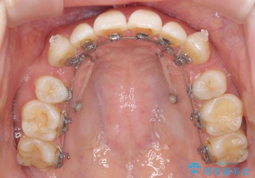目立たない裏側矯正で突出感を改善 ハーフリンガル矯正の治療中