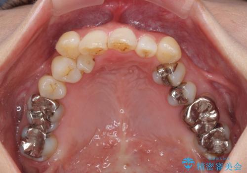 急速拡大装置 前歯の反対咬合をインビザラインで改善の治療前