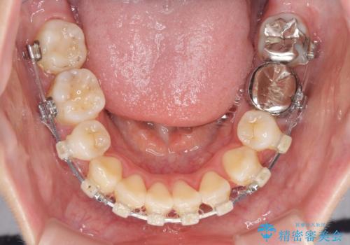 目立たない裏側矯正で突出感を改善 ハーフリンガル矯正の治療中