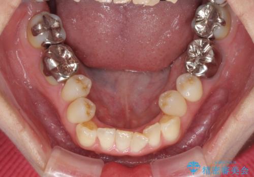 急速拡大装置 前歯の反対咬合をインビザラインで改善の治療前