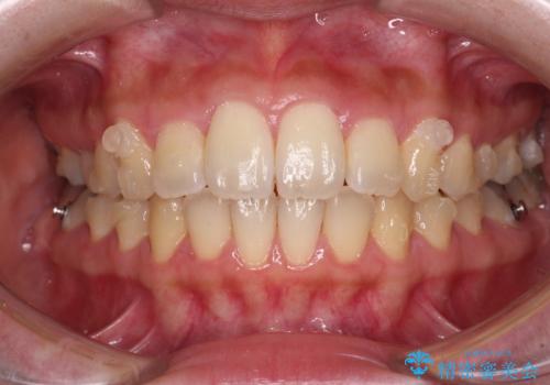 捻れた前歯をインビザラインでスッキリとの治療中