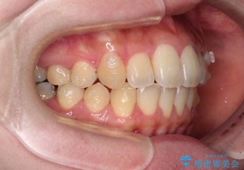 捻れた前歯をインビザラインでスッキリとの治療中