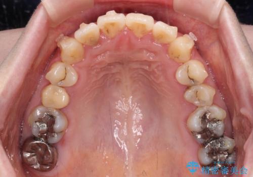 捻れた前歯をインビザラインでスッキリとの治療中