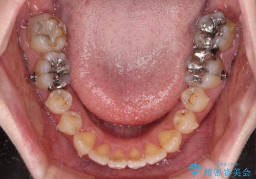 捻れた前歯をインビザラインでスッキリとの治療中