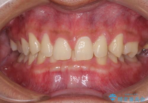 著しいディープバイトと隙間だらけの歯列 の症例 治療前