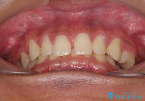 著しいディープバイトと隙間だらけの歯列 の治療前