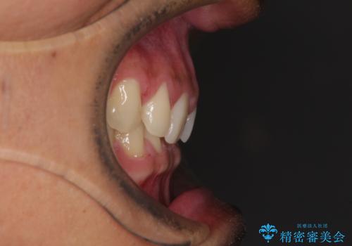 著しいディープバイトと隙間だらけの歯列 の治療前