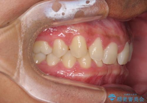 著しいディープバイトと隙間だらけの歯列 の治療前
