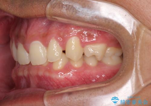 著しいディープバイトと隙間だらけの歯列 の治療前