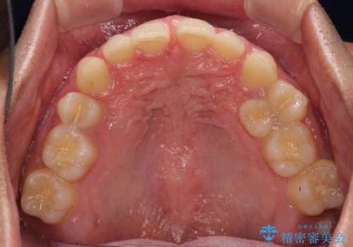 著しいディープバイトと隙間だらけの歯列 の治療前