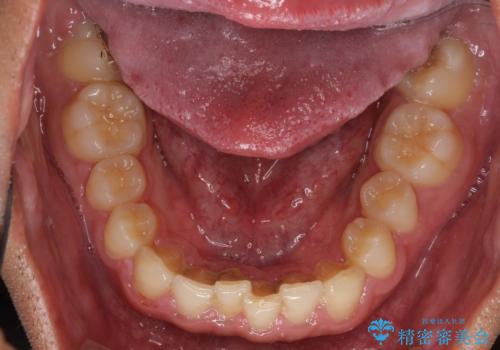 著しいディープバイトと隙間だらけの歯列 の治療前