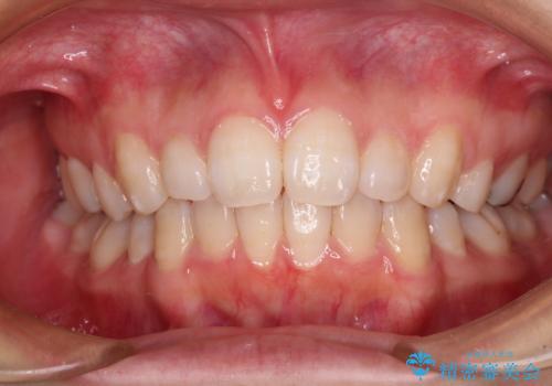 インビザライン・ライトで抜歯矯正の後戻りを解消の治療中