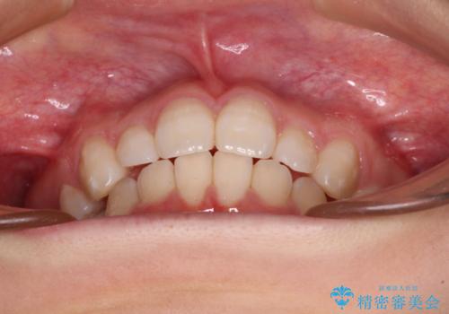 インビザライン・ライトで抜歯矯正の後戻りを解消の治療中