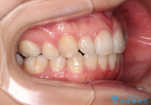 インビザライン・ライトで抜歯矯正の後戻りを解消の治療中