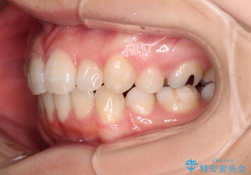 インビザライン・ライトで抜歯矯正の後戻りを解消の治療中