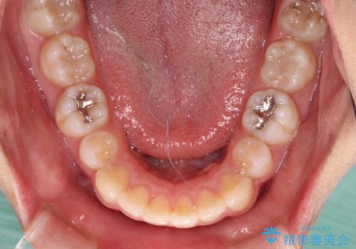 インビザライン・ライトで抜歯矯正の後戻りを解消の治療中